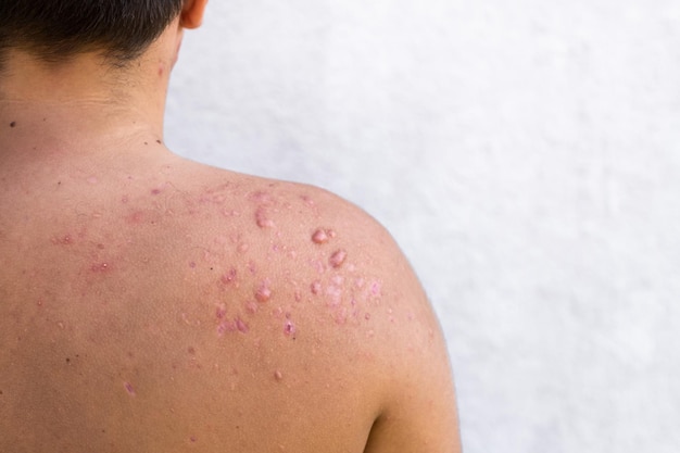 Acne occipital em um adolescente curou cicatrizes de acne adolescente nos ombros, infecções de pele e alergias ao corpo de um homem, cuidados de saúde e conceito médico