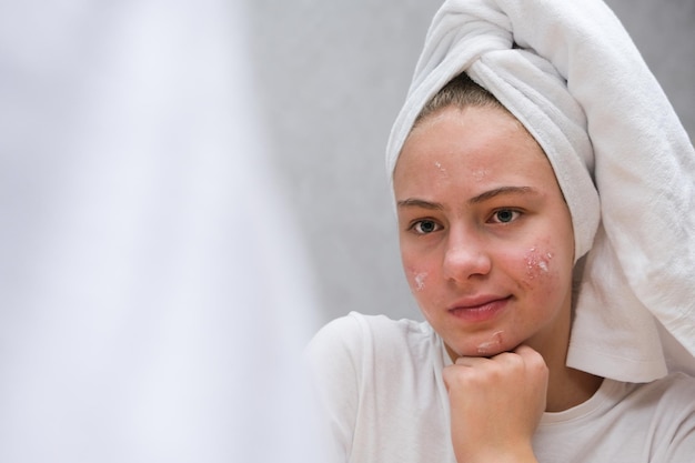 Acne. Uma adolescente torceu o rosto, o que ela não gosta por causa da acne. Pele adolescente problemática. Cuidar da pele problemática. remédio para acne.