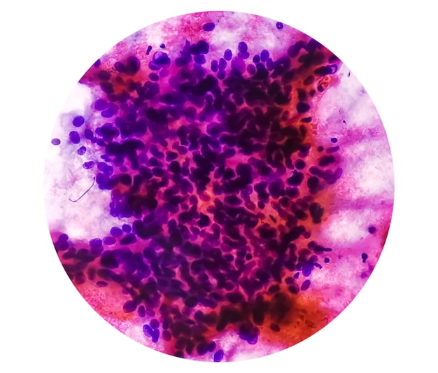 Adenocarcinoma metastásico. Adenocarcinoma papilar, un tipo de carcinoma de células no pequeñas.