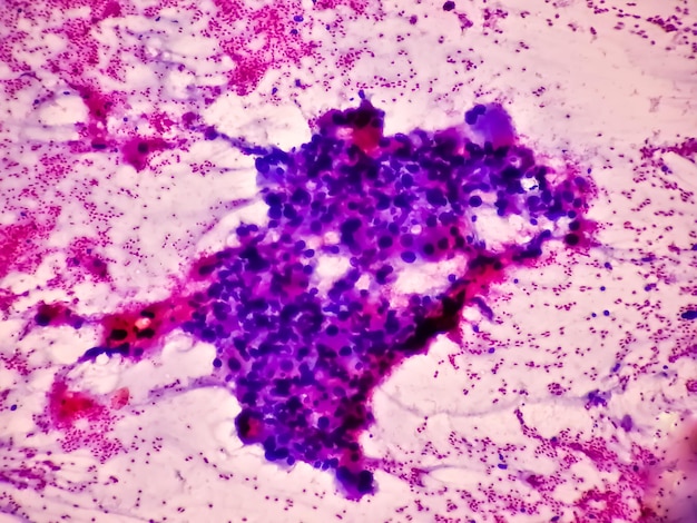 Adenocarcinoma metastático. Adenocarcinoma papilar, um tipo de carcinoma de células não pequenas.