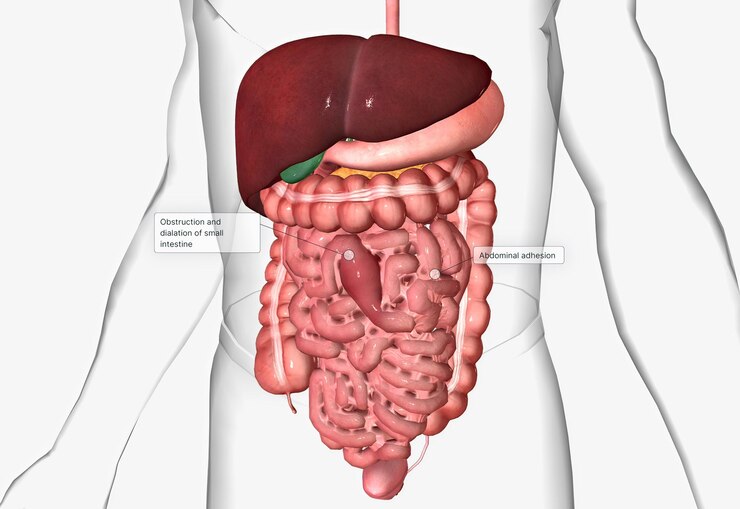 Foto aderências abdominais também chamadas de intestino delgado ou aderências gastrointestinais