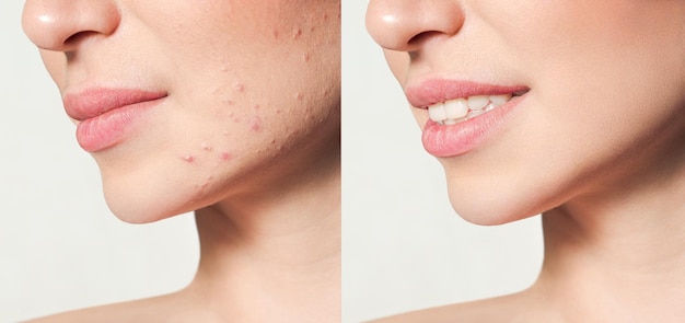 Adolescente antes e depois do tratamento da acne Conceito de cuidados com a pele Tratamento da acne em uma clínica de cosmetologia