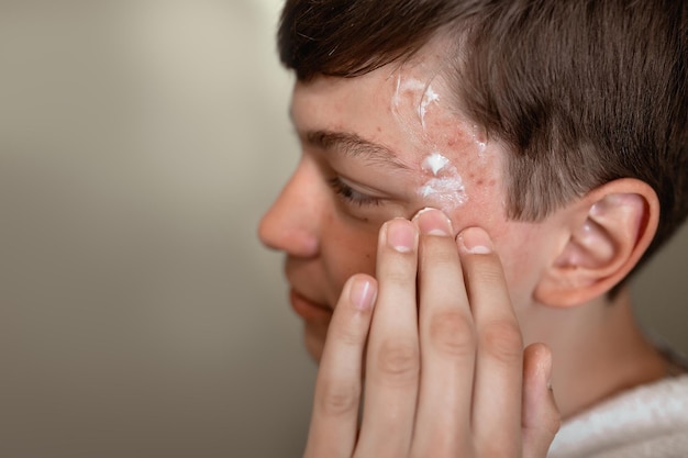 Adolescente com acne O cara mancha a acne com creme Creme para o rosto Creme para acne