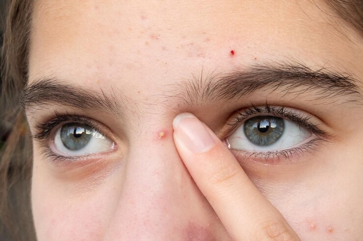 Foto adolescente tocando suavemente uma espinha no nariz