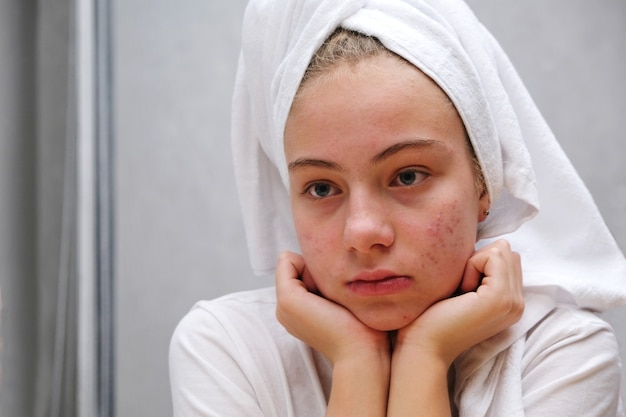 Foto una adolescente triste está mirando las espinillas de su rostro en el espejo. piel problemática en adolescentes. acné.