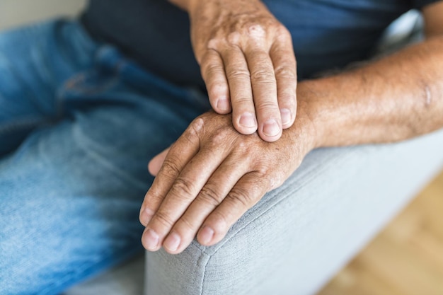 Foto Älterer mann, der an psoriasis an den händen leidet