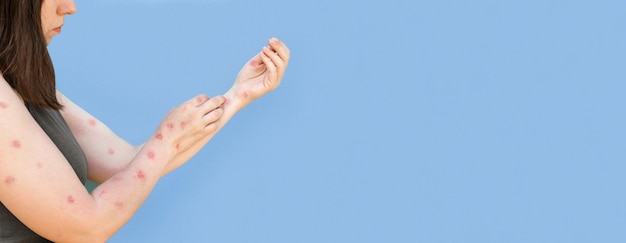 Affenpocken-Krankheit Patient mit Affenpocken-Ausschlag auf der Hand Hautausschlag menschlicher Hände Nahaufnahme Banner Kopierbereich