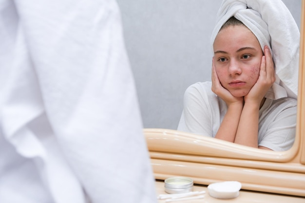 Foto akne. eine traurige teenagerin. problematische haut bei jugendlichen.