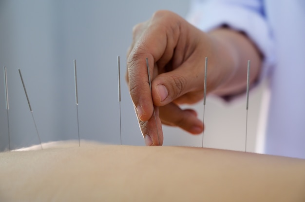 Akupunktur. Frauen, die die Rücken- und Akupunkturbehandlung im Salon sind