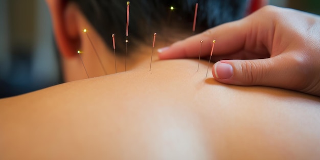 Akupunkturtherapie auf dem Rücken