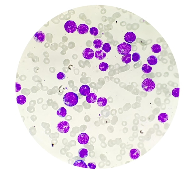 Akute Leukämie, peripherer Blutausstrich zeigen, dass die meisten Zellen Blasten mit reichlich Zytoplasma sind