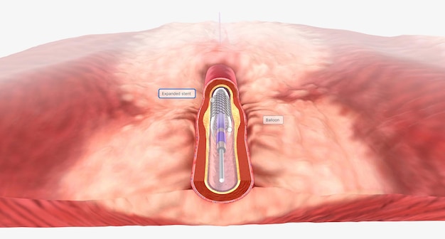 Al llegar al área de acumulación de placa en la arteria coronaria, el globo se infla y el stent se expande.