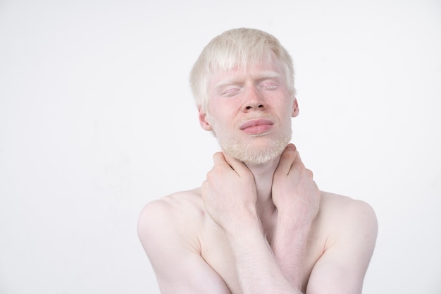 Albinismo homem albino em estúdio vestido de camiseta isolada em um fundo branco. desvios anormais. aparência incomum. anormalidade da pele