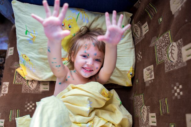 La alegre niña enferma de varicela se encuentra en una cama y muestra palmas.