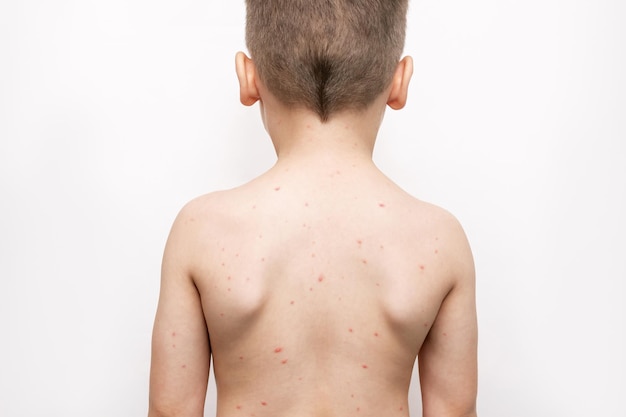 Alergias al sarampión a la varicela El niño de pie con la espalda con una erupción roja en el cuerpo