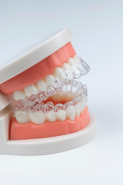 Alinhadores invisíveis e removíveis para alinhamento dentário