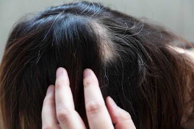 Alopecia e cabelos grisalhos na cabeça de uma mulher estresse e problemas de saúde closeup gray background