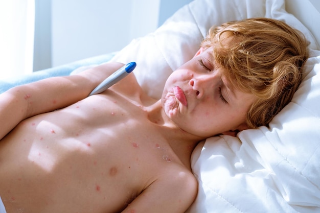 Alto ángulo de un niño triste y enfermo con sarpullido de varicela en el torso desnudo cerrando los ojos y haciendo pucheros mientras descansa en la cama y mide la temperatura durante el día