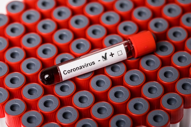 Amostra de sangue covarde de 19 negativos no tubo de amostra na tabela no laboratório de pesquisa. Coronavírus, pesquisa de 19 vacinas cobertas.