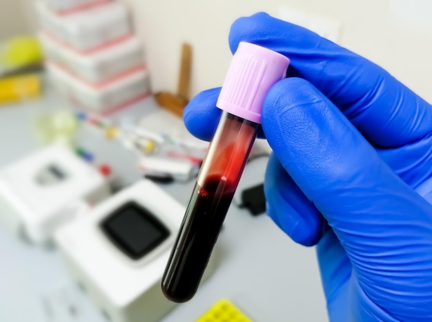 Amostra de sangue em tubo de lavanda para análise bioquímica ou análise hematológica ou teste de PCR