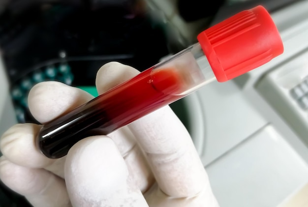 Amostra de sangue hemolisada na mão do cientista que pode causar resultado de teste falso