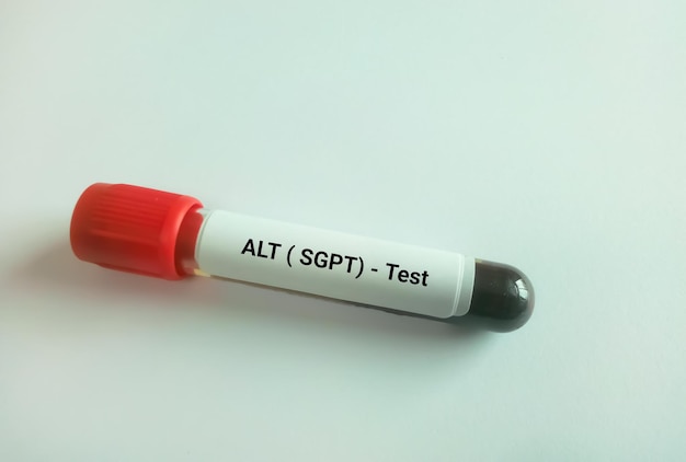 Amostra de sangue isolada para teste de ALT ou SGPT para teste de função hepática