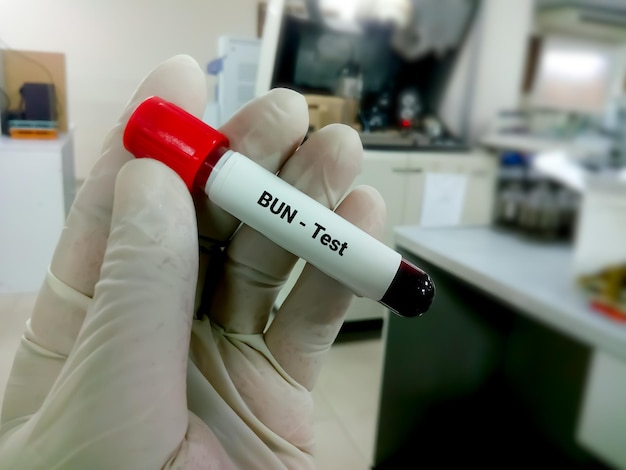 Amostra de sangue para BUN ou teste de nitrogênio de ureia no sangue
