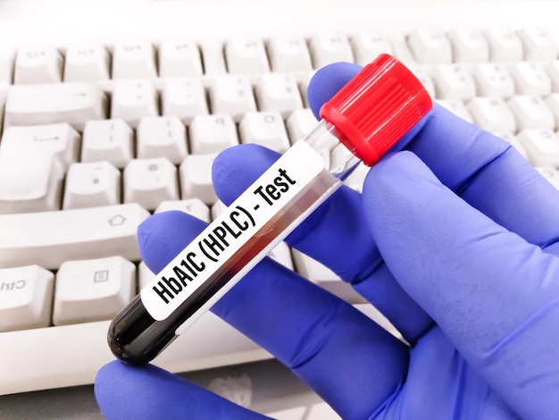 Amostra de sangue para HbA1c - teste de HPLC, diagnóstico de diabetes em laboratório.