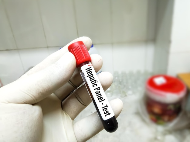 Amostra de sangue para painel hepático, teste anti-hbs no laboratório médico.