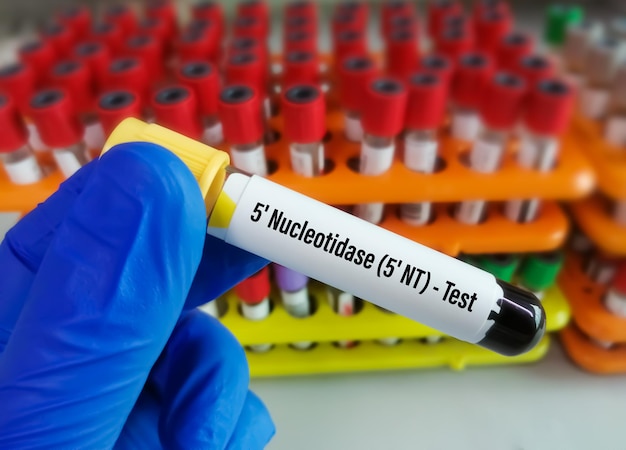 Amostra de sangue para teste de 5'-nucleotidase (5'-NT), investigar a origem do aumento da ALP sérica