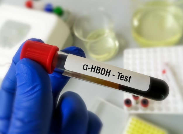 Amostra de sangue para teste de alfa hidroxibutirato desidrogenase, diagnóstico de infarto do miocárdio.