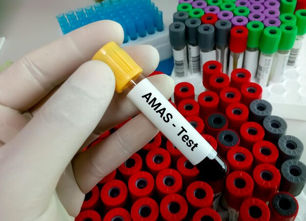 Amostra de sangue para teste de AMAS ou Anticorpo Anti-Malignin