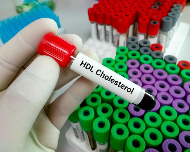 Amostra de sangue para teste de colesterol HDL ou HDL C ou colesterol bom