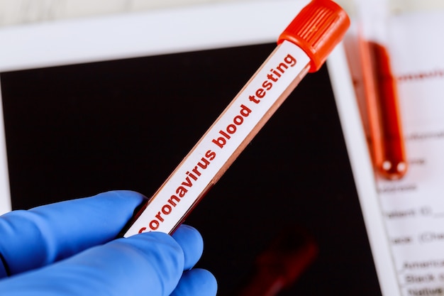 Amostra de sangue para teste de Coronavírus