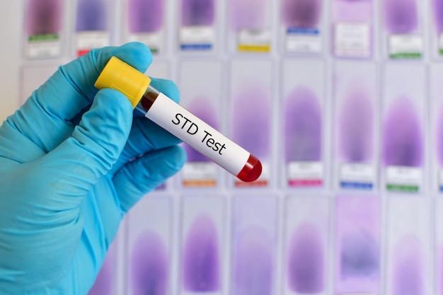 Foto amostra de sangue para teste de dst de doenças sexualmente transmissíveis