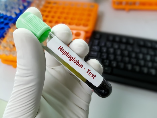 Foto amostra de sangue para teste de haptoglobina para o diagnóstico de anemia hemolítica