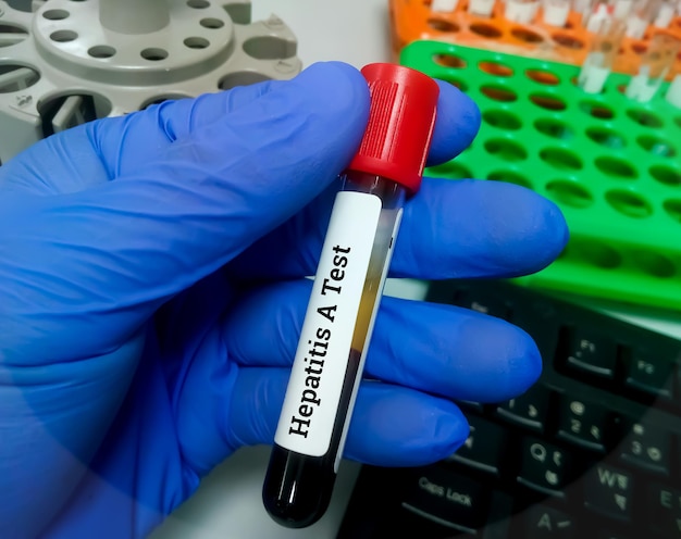 Amostra de sangue para teste do vírus da hepatite A