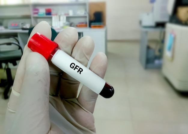 Amostra de sangue para TFG ou teste de taxa de filtração glomerular