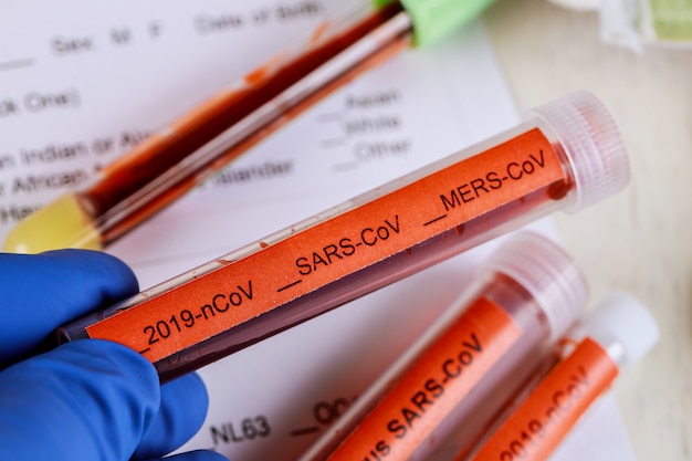 Foto amostras de sangue para teste de coronavírus