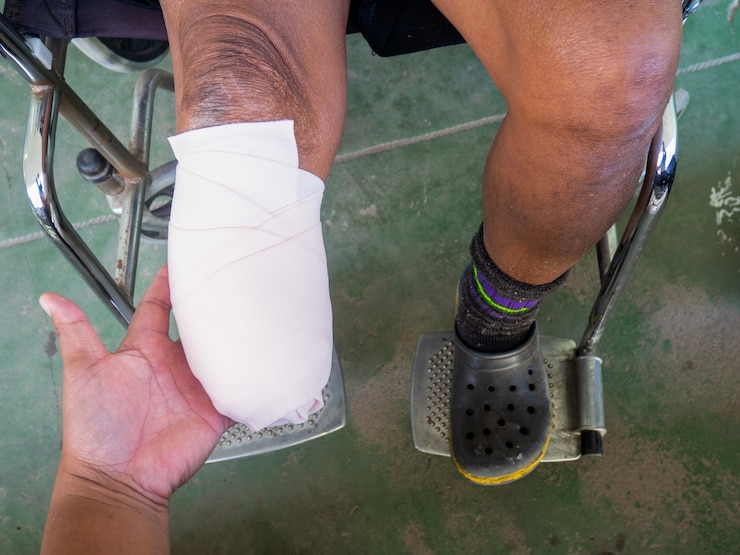 Foto amputación por debajo de la rodilla con vendaje elástico