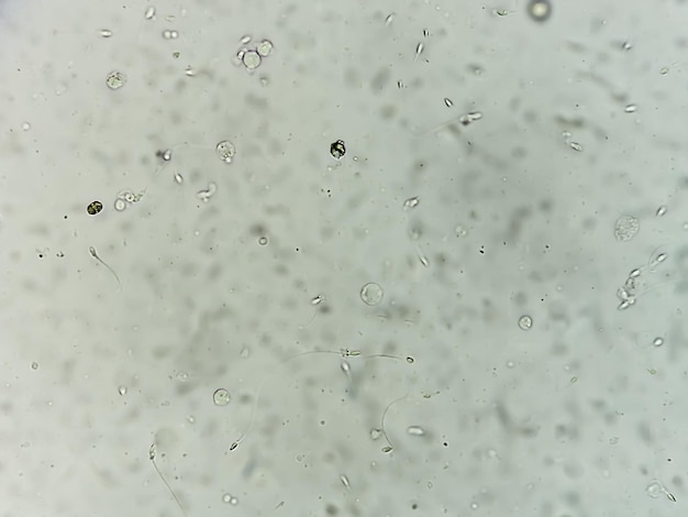 Análise do sêmen sob microscopia mostrando piospermia ou leucocitospermia. Análise de esperma.