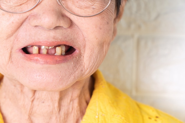 Una anciana asiática de más de 70 años sonríe con algunos dientes rotos.