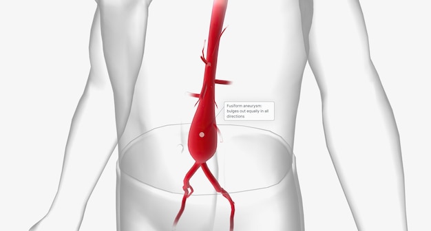 Foto el aneurisma fusiforme sobresale por igual en todas las direcciones