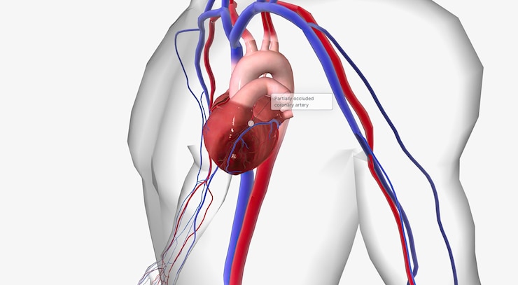 Foto la angina es dolor o malestar en el pecho debido a la reducción del flujo sanguíneo al corazón.