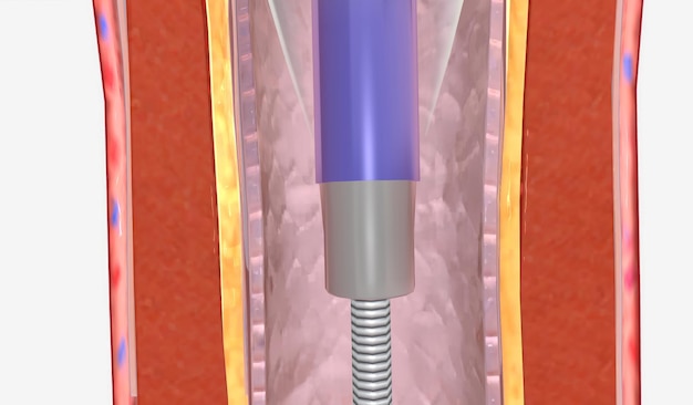 Foto angioplastie ist ein minimalinvasives verfahren, bei dem ein katheter mit einer ballonspitze verwendet wird, um ihre verstopfte arterie zu erweitern