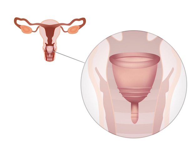 Anleitung zur Verwendung der Menstruationstasse während der Periode Weibliches Fortpflanzungssystem auf weißer Hintergrundillustration