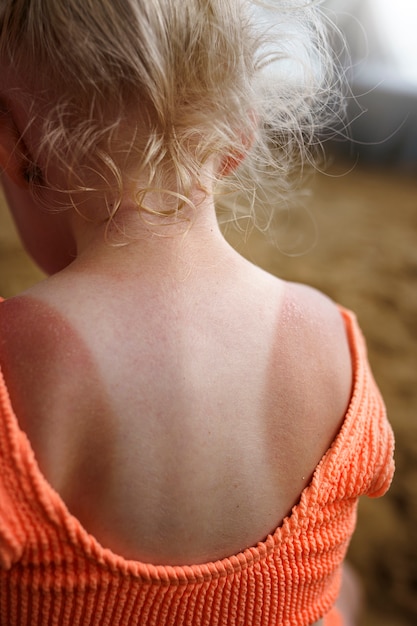 Foto ansicht eines jungen mädchens mit sonnenbrandhaut am strand