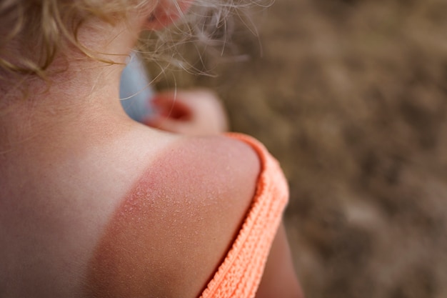 Foto ansicht eines jungen mädchens mit sonnenbrandhaut am strand