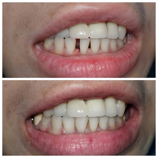 Antes y después del cierre de la enorme brecha entre los dientes inferiores diastema