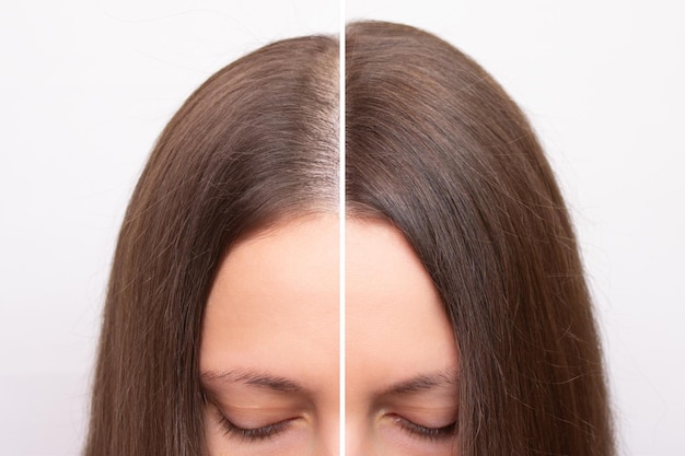 Antes y después de la foto de una mujer joven con una línea de cabello en la frente y la separación
